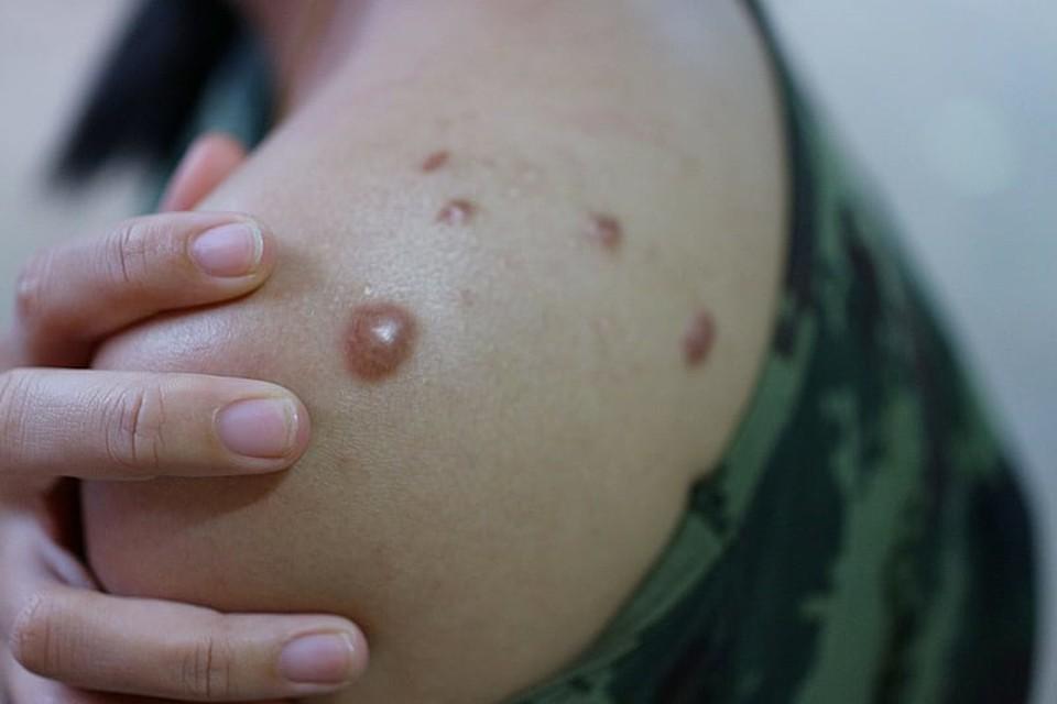 MP do Pará fiscaliza ações da saúde contra avanço da Mpox - 